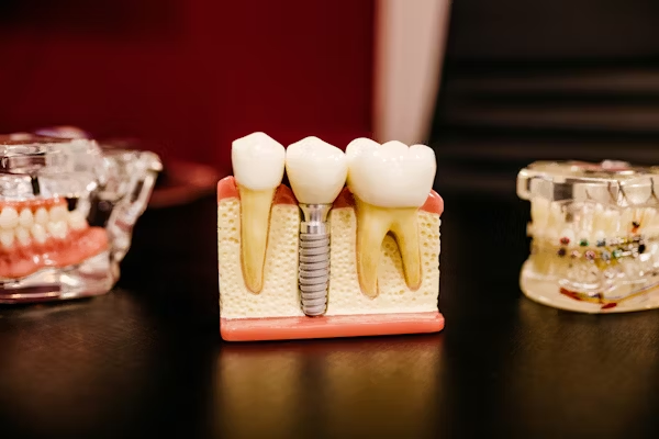 image showing a jaw model with a single dental implant between two healthy teeth