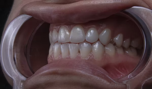a photo showing a person's mouth with bite blocker