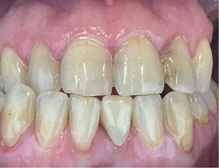 pt 2 after same day veneers