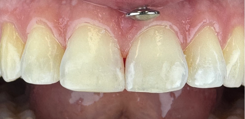 pt 3 after direct composite on incisal