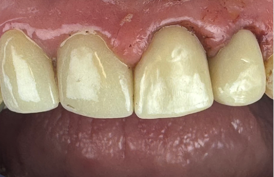 pt 4 same day crown after