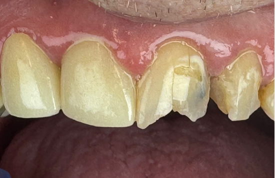 pt 4 same day crown before
