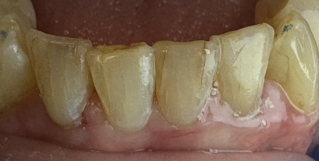 pt no.1 after. incisal edge direct composites