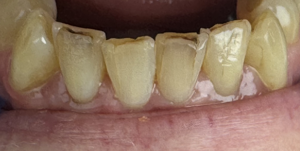 pt no.1 before