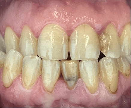 before and after (1)