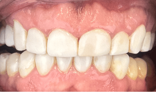 composite veneers repair after