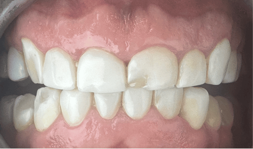 composite veneers repair before
