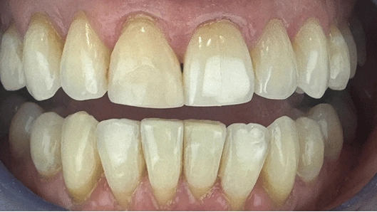 pt 5 after
