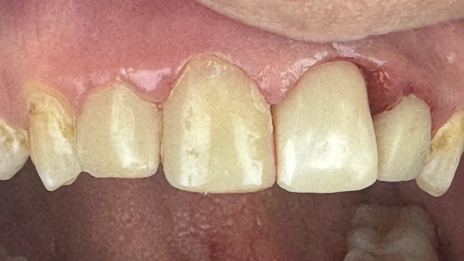 pt no. 8 after. direct composites on 7 and 8